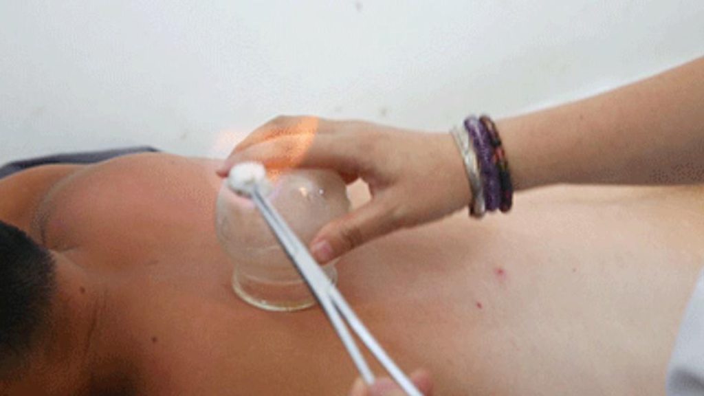 Common methods of cupping1