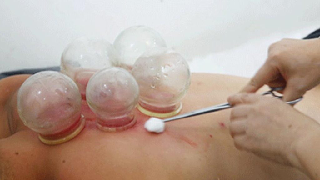 Common methods of cupping3