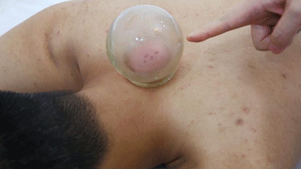 Common methods of cupping4