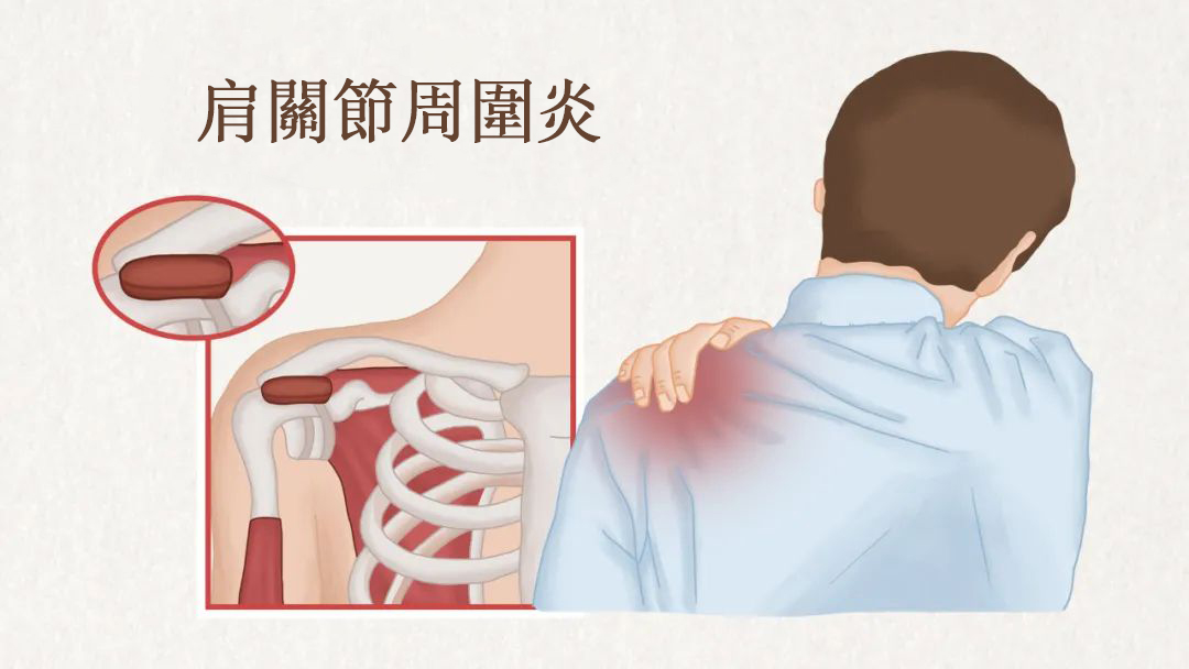 exercise methods for frozen shoulder1