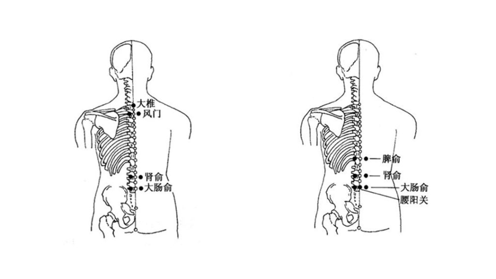 Cupping method to relieve back pain 5