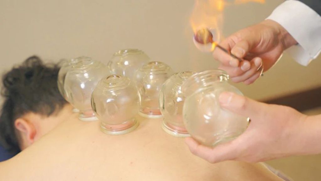 The principles and benefits of cupping2